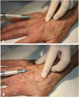 Esthetique Genève - Injections Radiesse dans les mains