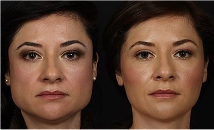 Botox dans la mâchoire contre le bruxisme ou une mâchoire trop large