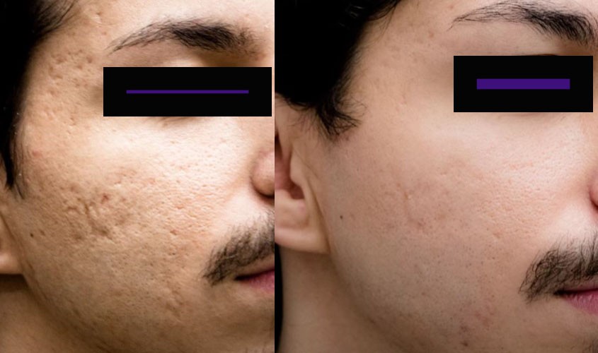 Laser CO2 cicatrices d'acné