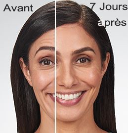 Esthetique Genève-Injections Botox