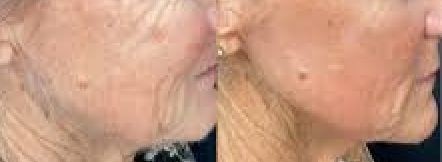 Esthetique Thonon -atténuation rides joues