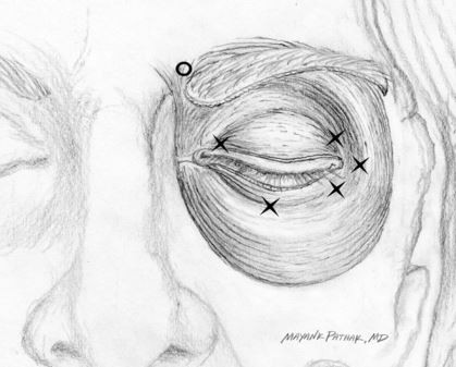 Esthetique Genève- Injections Botox - Blepharospasme