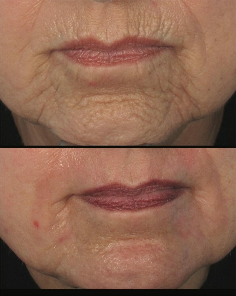 Esthetique Thonon -atténuation rides péribuccales