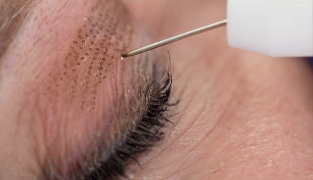 Esthetique Genève - Plasma pen paupières procédure blépharoplastie