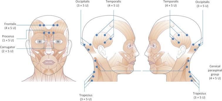 Treatment of migraines with BOTOX | Esthetiques Geneve