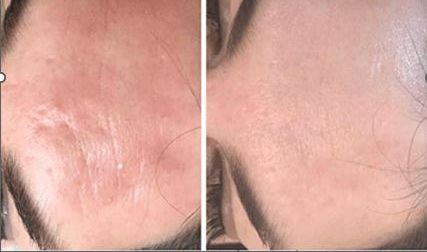 Esthetique Thonon - Effacement cicatrice au Laser