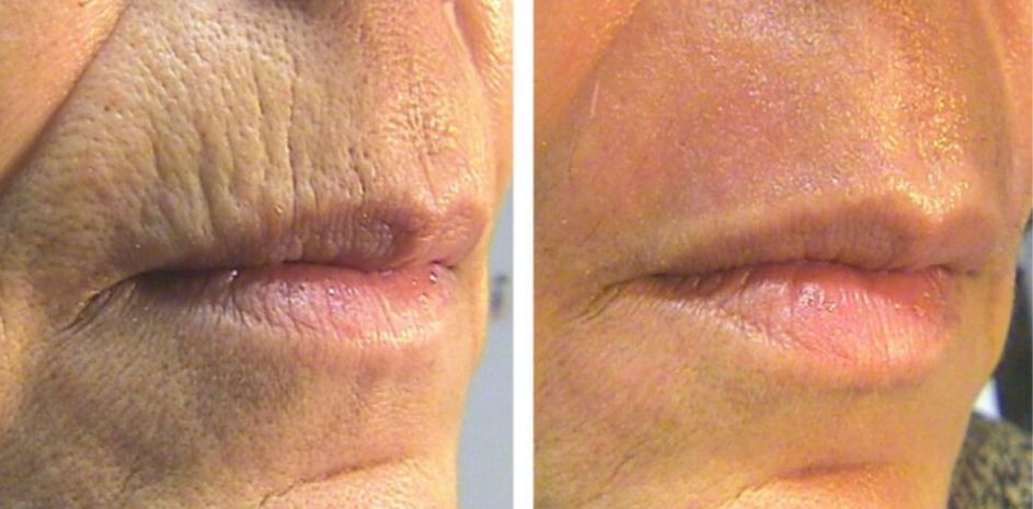 Esthetique Thonon -atténuation rides lèvres