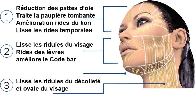 Esthétique Genève - indications PlexR Plasma pen