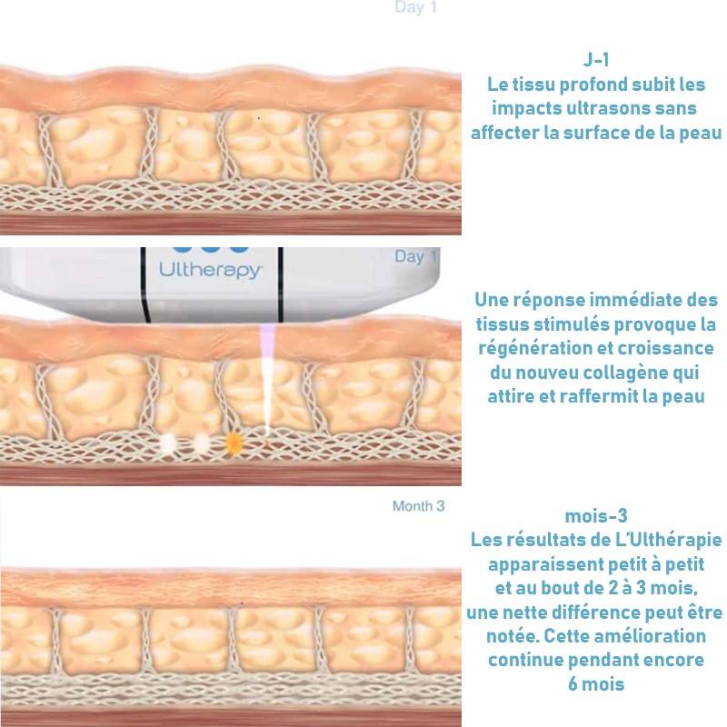 Esthétique Genève - comment fonctionne l'ULtherapy