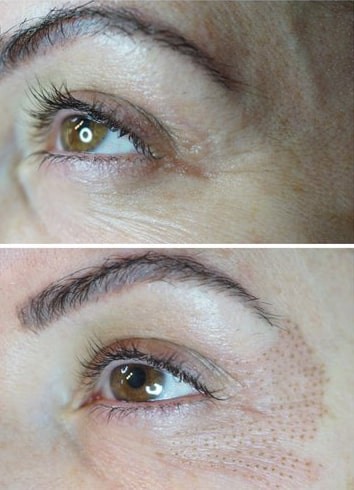 PLASMA ION EYE LID LIFT + EYE BAGS TREATMENT – Novopelle Med Spa