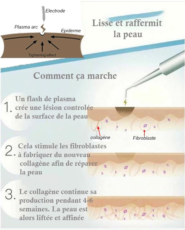 Esthétique Genève - comment fonctionne le plasma pen Plex-R