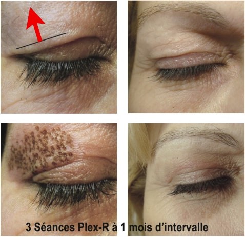 Esthetique Genève - Plasma pen paupières résultat blépharoplastie