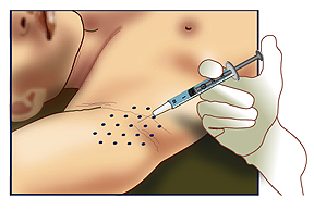 Esthetique Genève - Injections Botox pour hypersudation axillaire des aisselles