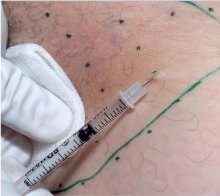 Esthetique à Genève - Injections Botox pour transpiration aisselles