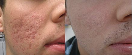 Traitement laser CO2 des cicatrices d'acné proche Genève