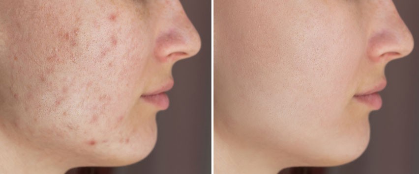 Avant après cicatrices d'acné laser CO2