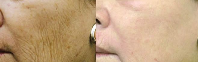 Esthetique Thonon - atténuation rides joues