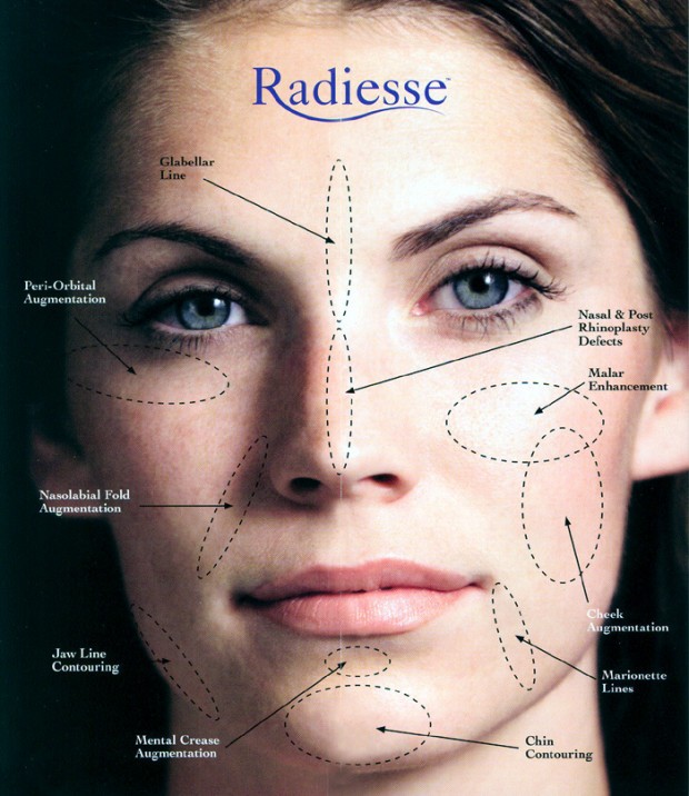 Esthetique Genève - Injections Botox et Filler- Zones