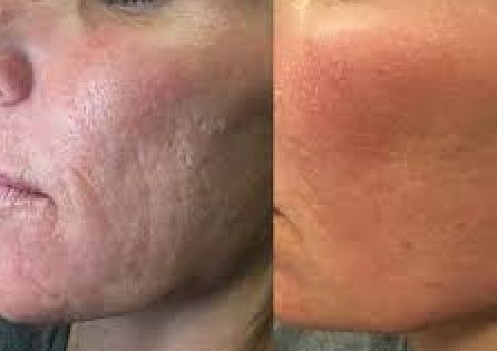 Esthetique Thonon -atténuation rides joues