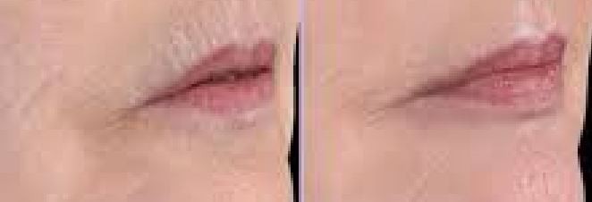 Esthetique Thonon -atténuation rides lèvres