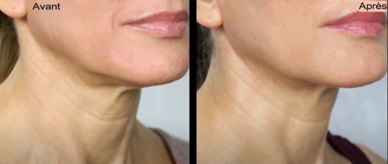 Avant / Après : Comparatif photos traitement Botox et acide