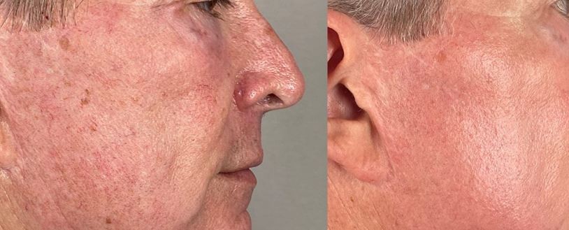 Esthetique Thonon - atténuation rides joues