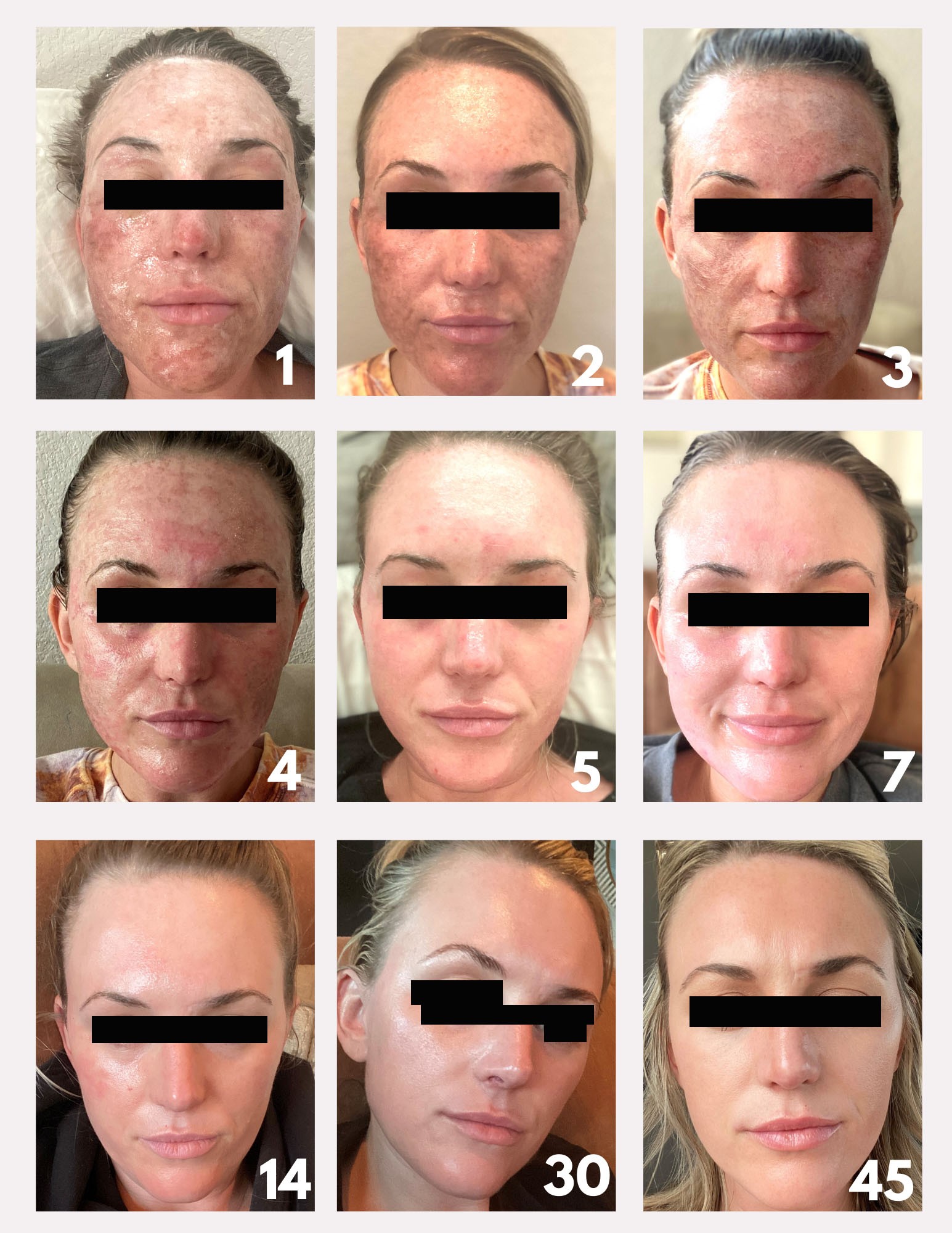 Evolution après laser CO2 de J0 à J45